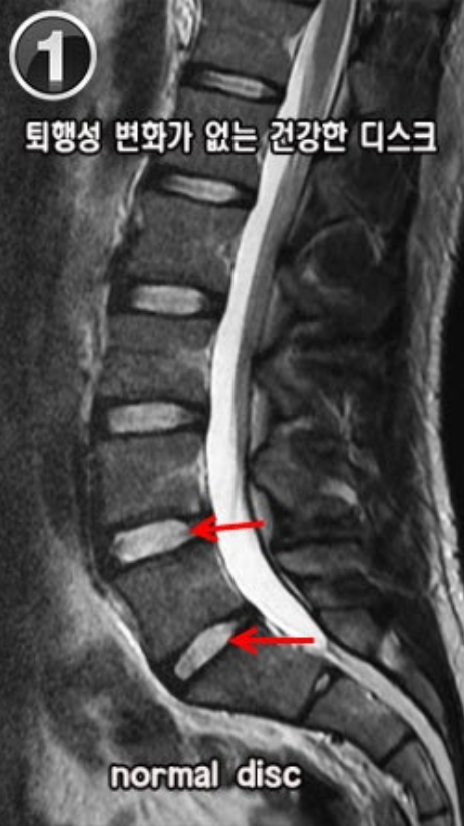 카페 MRI 설명 자료에 실린 척추 영상과 안내 표시